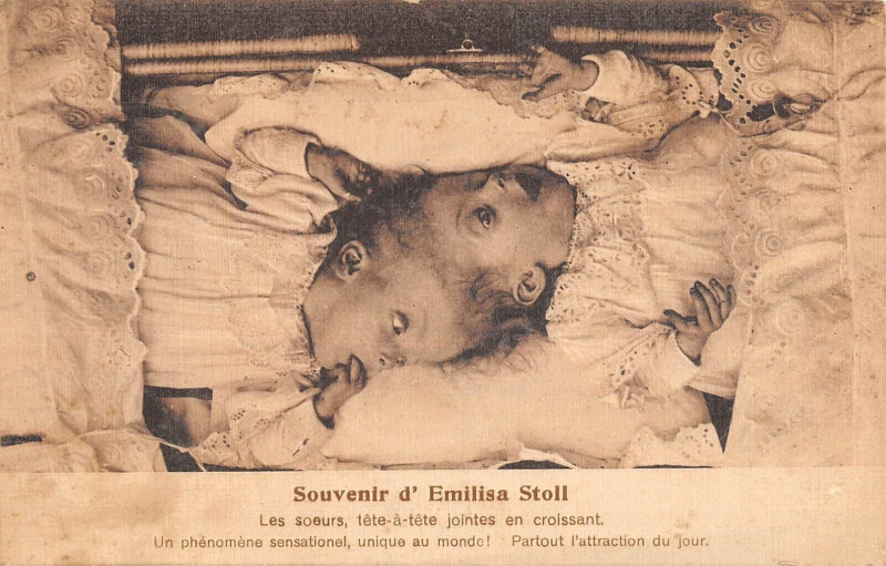 Carte postale ancienne Medecine Monstre Souvenir D'Emilisa Stoll Soeur A Tete Jointes En Croissant